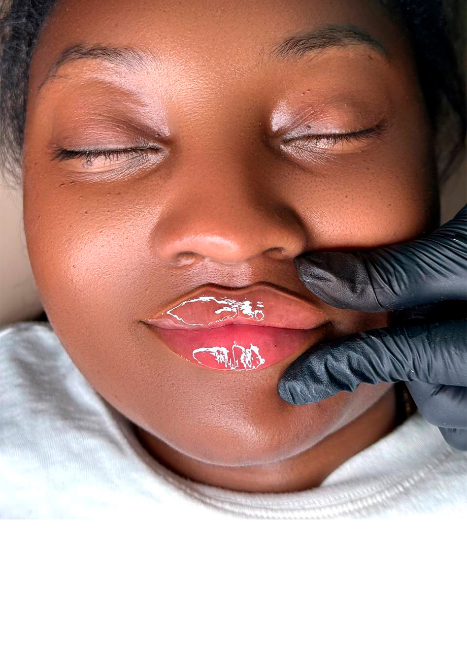 How to properly care for your lips after augmentation